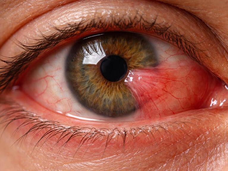 clinica de ojos ruiz montenegro services 1 pterigion