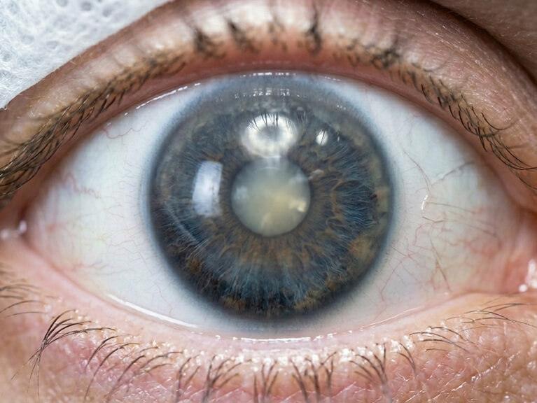 clinica de ojos ruiz montenegro services 1 catarata